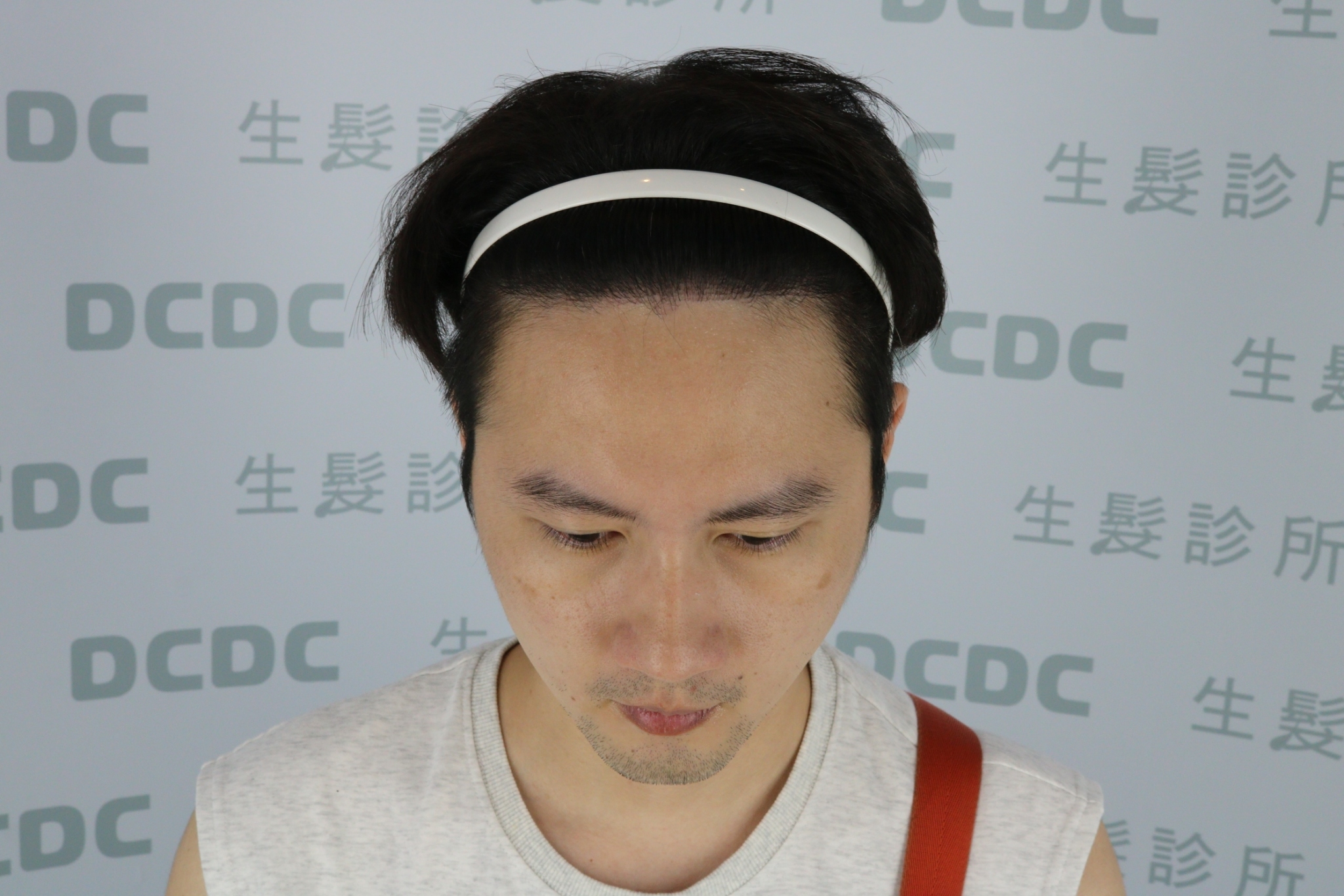 DCDC生髮診所-柯博桓醫師前額植髮術後9個月自然濃密正面成果